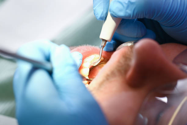 Best Emergency Root Canal Therapy in Osawatomie, KS